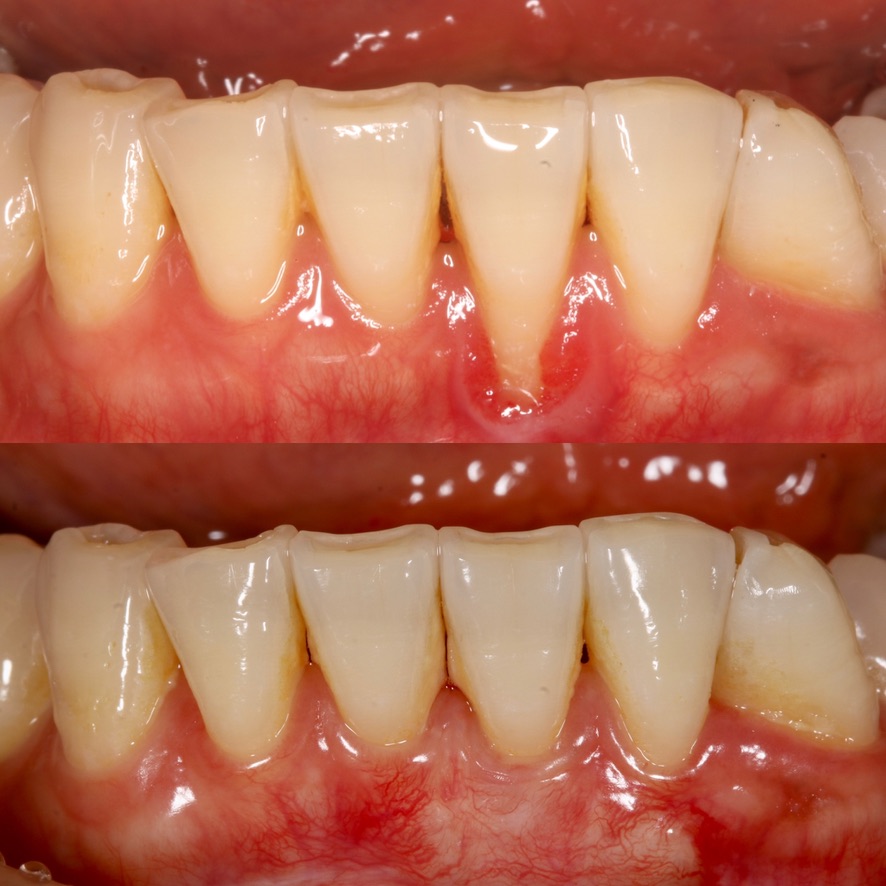 Lower front tooth gum recession before and after grafting