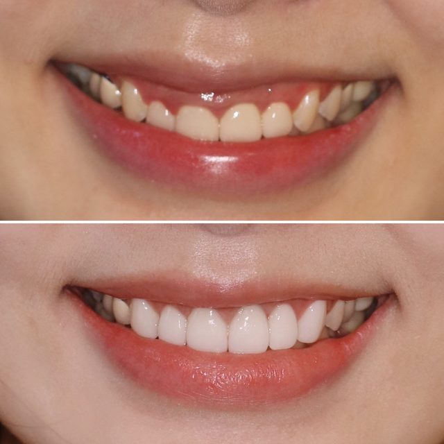 Crown lengthening and crowns treatment result