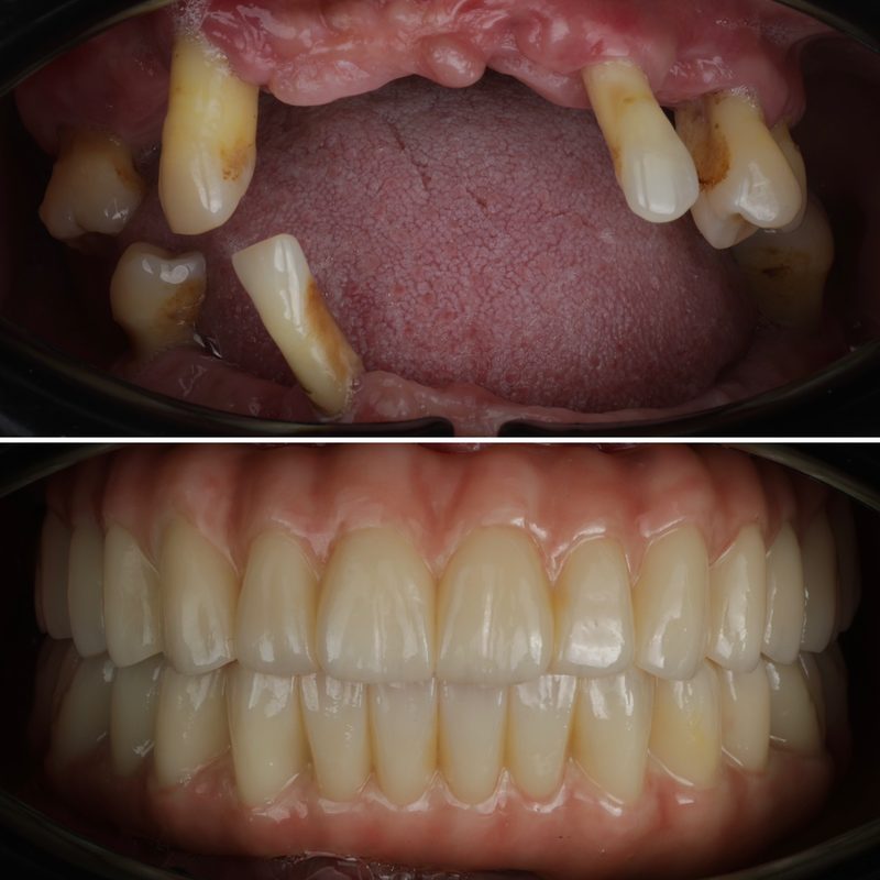 Dental implant restoration before and after