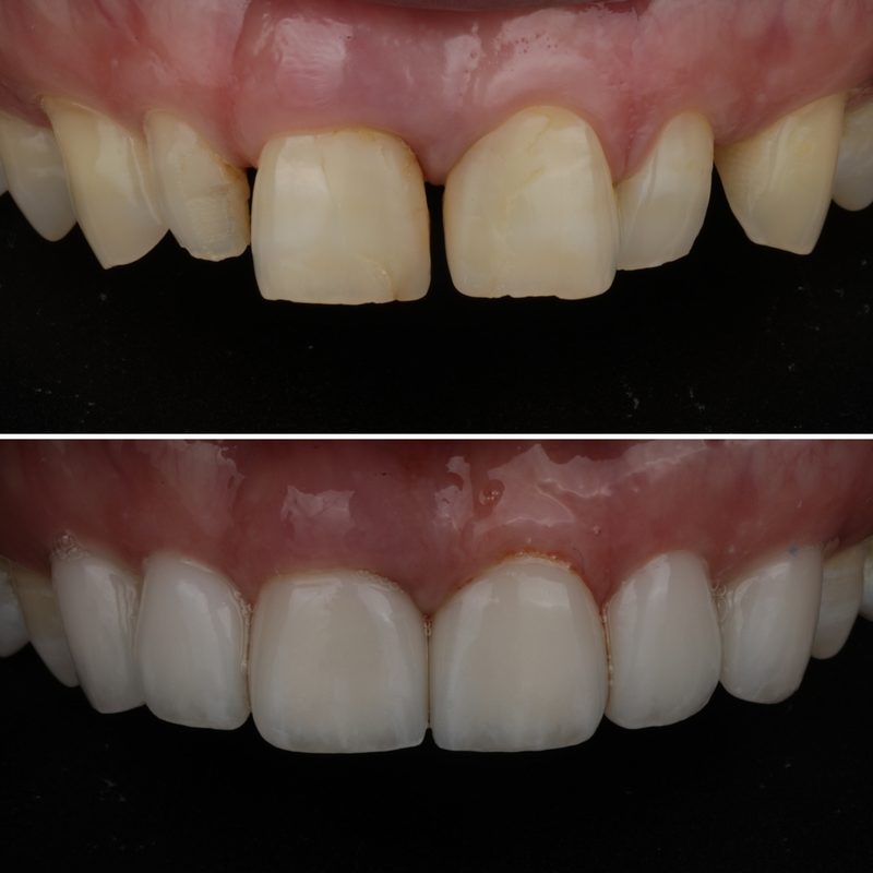 Discolored front teeth restored with porcelain veneers