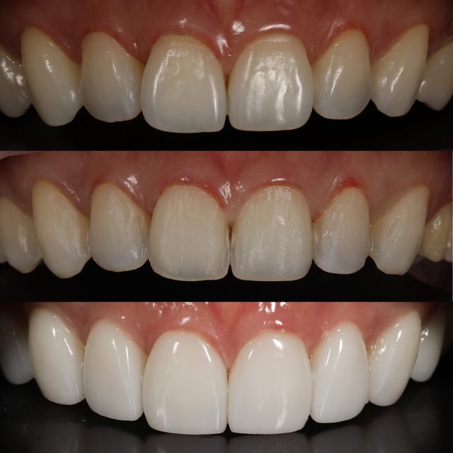 Porcelain veneer case before and after