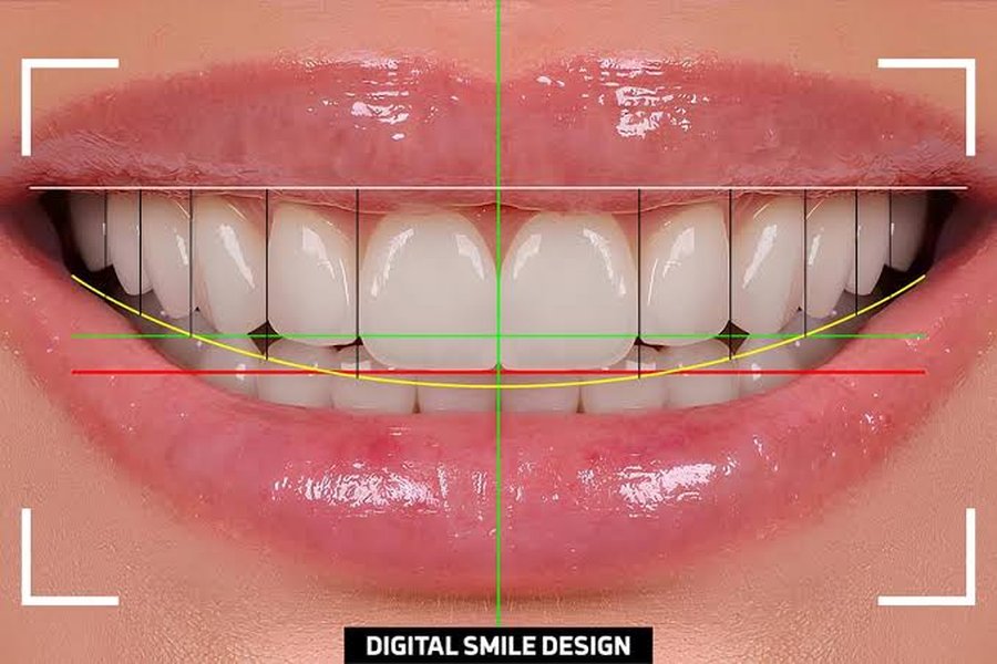 Digital smile design for porcelain veneers