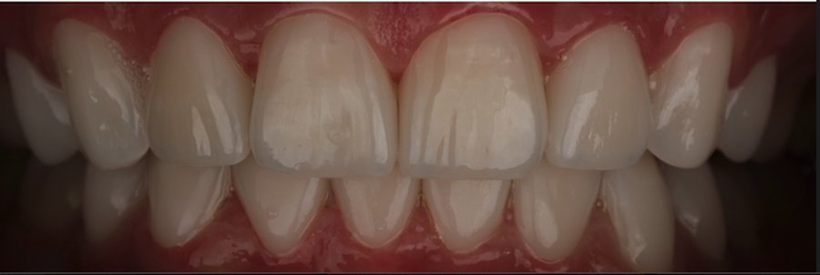 Natural smile after porcelain veneer bonding